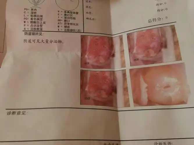 大家帮忙看看有没有宫颈糜烂跟宫颈炎,医生说宫颈都烂啦,吓死我啦!