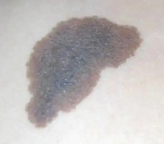 色素痣|胎记|小偏方_网易订阅