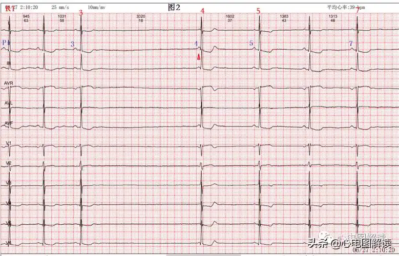 过缓的交界性逸搏,窦性停搏,房室分离_心律_房性_心室