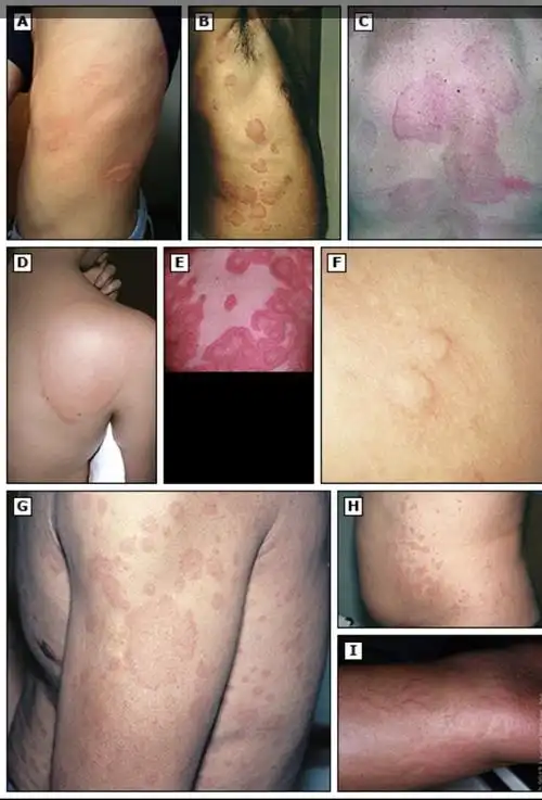 急性荨麻疹荨麻疹是一种常见的疾病,人群患病率约20%.