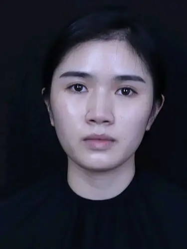 【术前】我鼻梁不是很塌的那种,就是侧面看山根很低,_圈子-新氧美容