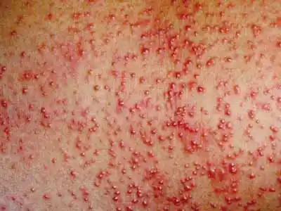 痱子跟湿疹的图片