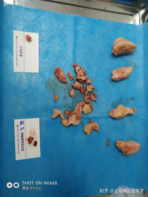 子宫腺肌症的治疗方法你选切子宫还是做保宫手术