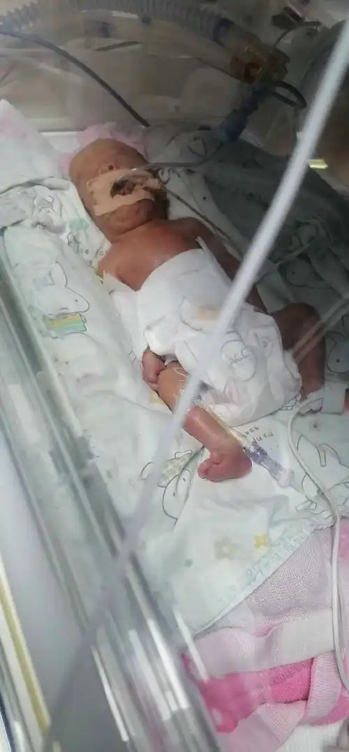 胎龄26周体重980克