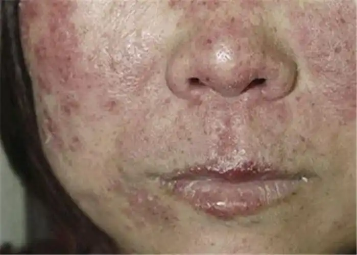 老人红斑狼疮早期脸部症状图片