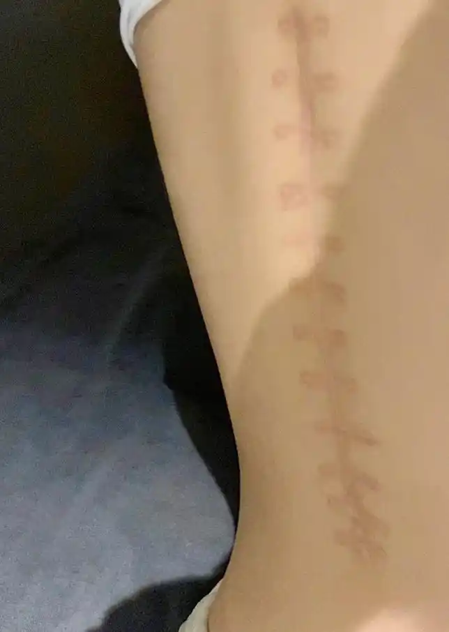 三块钢板和数枚螺钉植入她的身体中,在左右脚踝各自留下一处l形疤痕.