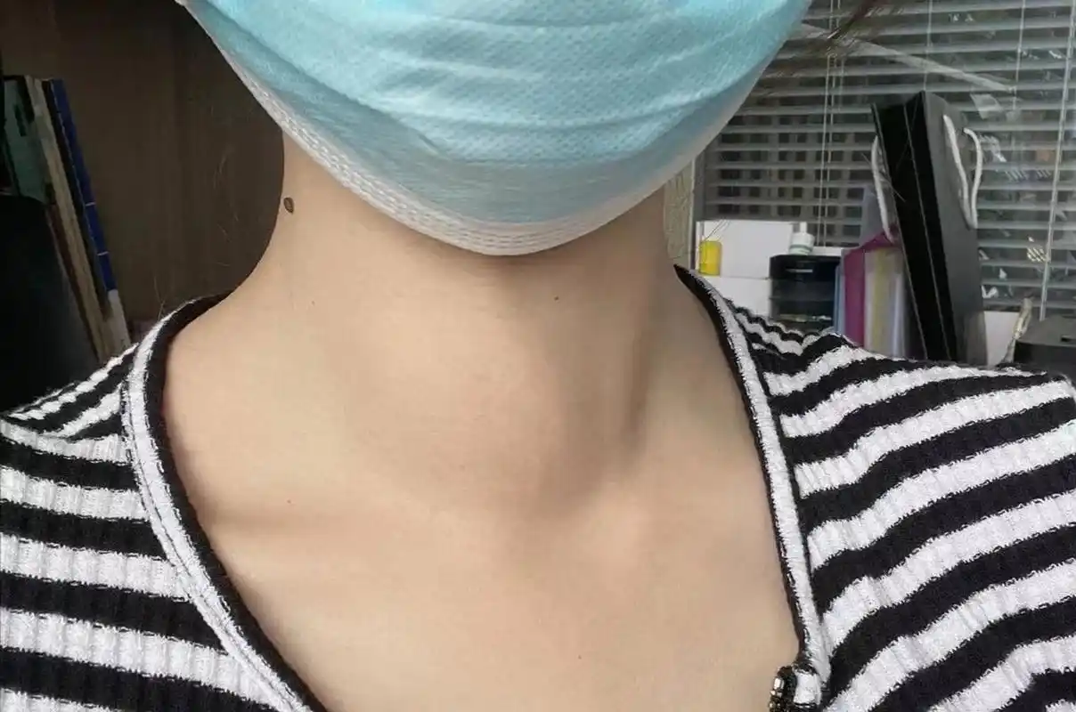 甲亢好了,与过去的粗脖子说再见