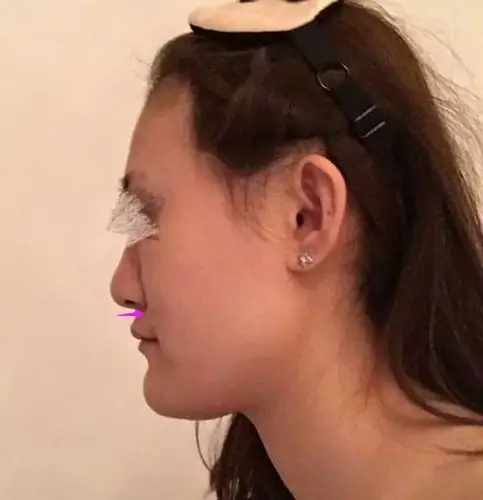 鼻翼基底凹陷,需要填充抬高改善,面部更平整饱满,同时也改嘴唇,咬合