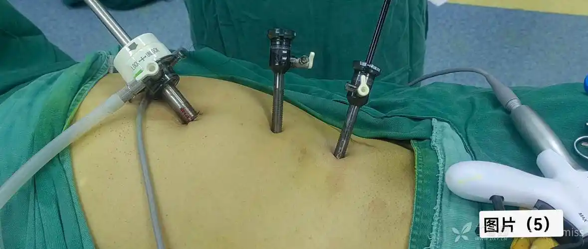 腹腔镜下完全腹膜外右侧腹股沟直疝补片修补术