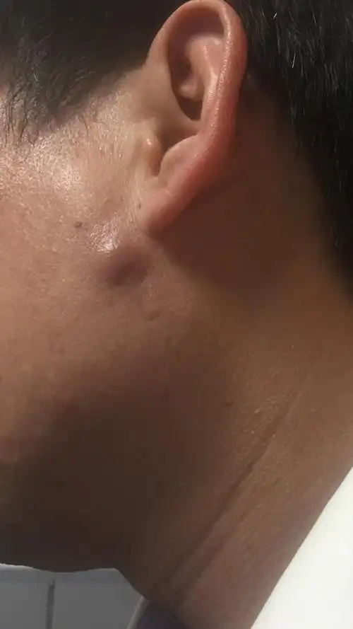 耳下长了一个包,红,压着有痛感