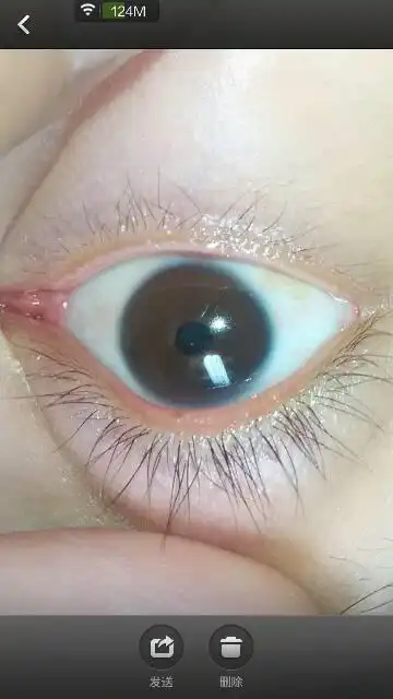 长眼睫毛的下面长水泡,除了长水泡眼睛痒的时候揉了一会,眼皮就肿了