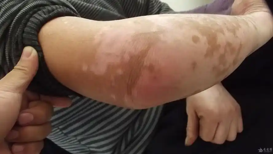 右侧肘部红肿疼痛加重5天大家帮忙看看