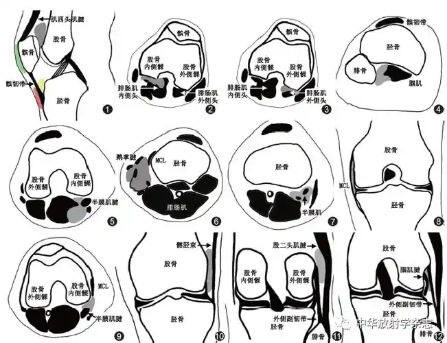 【继续教育讲座】膝关节周围滑囊及其相关疾病的mri 表现
