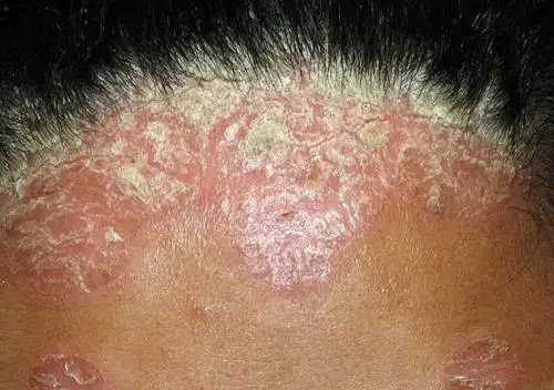 长春肤康医院浅谈:老年人易出现头皮牛皮癣,4种方法可缓解