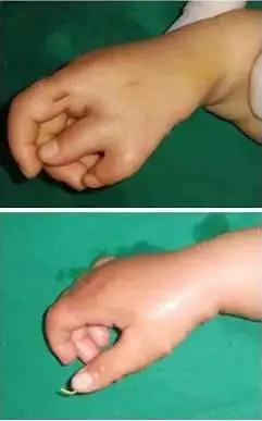 杭州复旦儿童医院治疗多指效果怎么样?