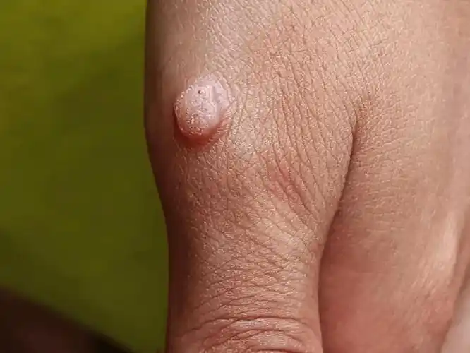 就初步判断这是感染了hpv,诱发了寻常疣,于是给小朱开了hpv的检查单