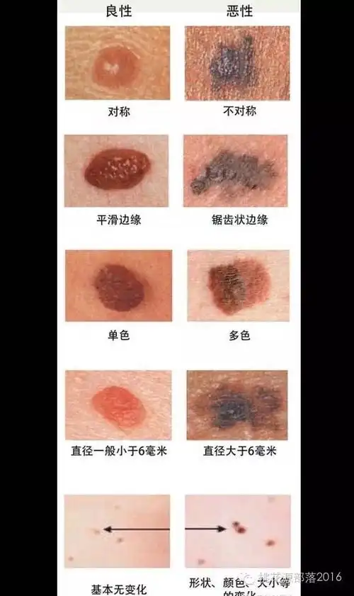 痦子位置解说图(痦子位置解说图女生)