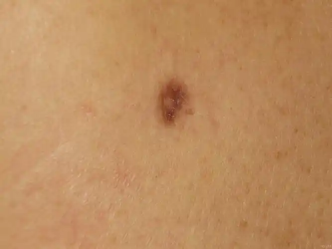 典型病例——真皮纤维瘤 - 皮肤及性传播疾病讨论版 - 爱爱医医学论坛