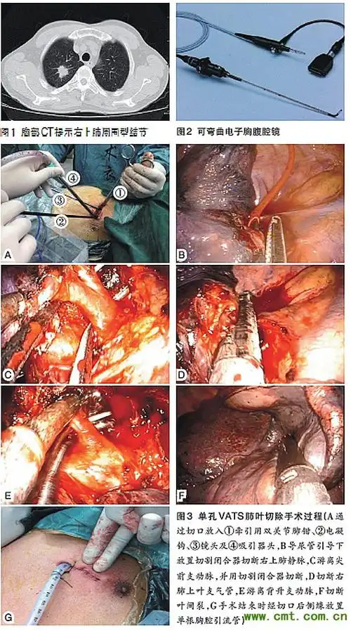单孔电视胸腔镜切除右肺腺癌