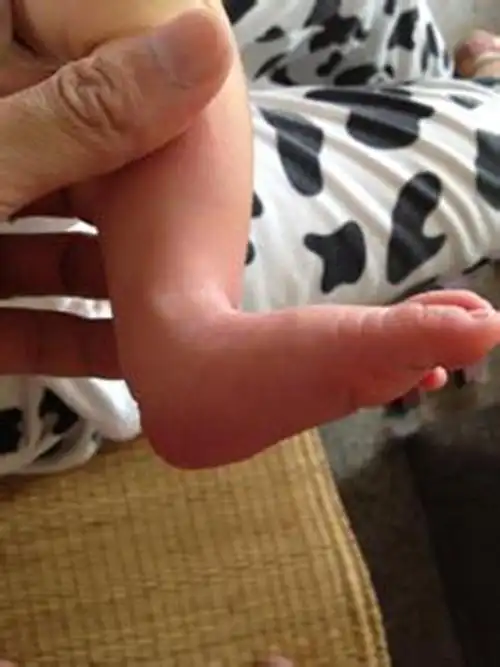 油尖旺区足外翻专家_油尖旺区治疗足外翻哪个专家好_油尖旺区治疗足