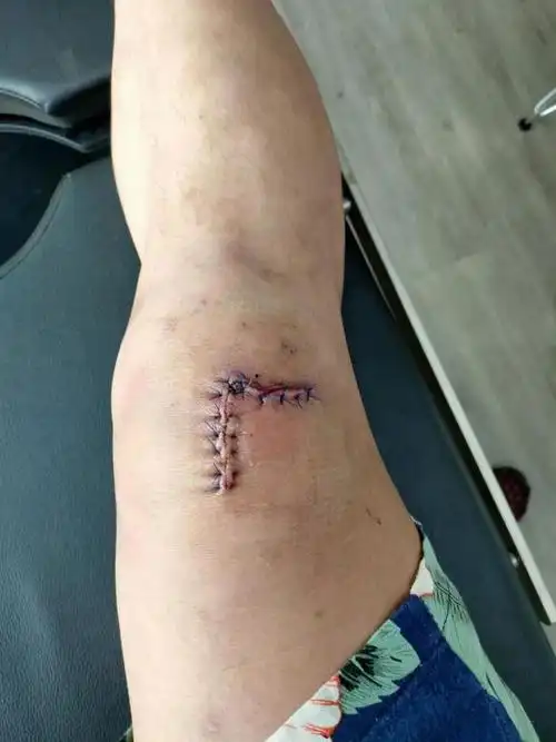 中国客工爆料受伤3个月缝12针新加坡不赔工伤的原因竟是