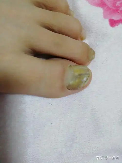 记录伊曲康唑治灰指甲