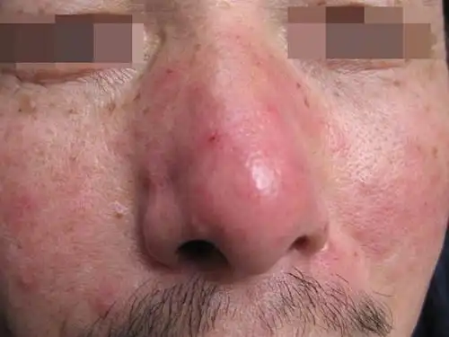 多并发皮脂溢,颜面犹如涂脂,严重的影响患者的容貌,那面部酒糟鼻患者