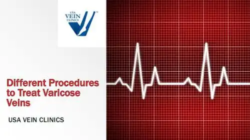 varicose veins treatment procedures - usa vein clinics