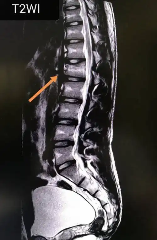 腰椎第一节骨折能评几级伤残 交通事故腰椎第一节压缩性骨折是几级