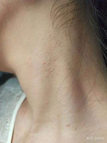 皮肤问题:粟丘疹 - 知乎
