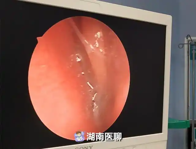 14岁少女鼾声如雷响过父亲鼻腔内长满了这个