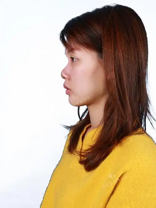 术前诊断术前患者鼻梁塌陷,没有轮廓感,山根低平,鼻_圈子-新氧美容