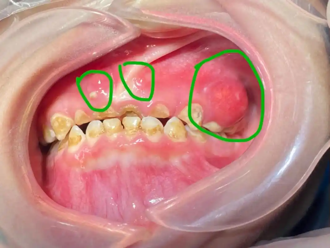 5岁的小孩牙齿肿痛得厉害,经常涨脓包,做父母的都是希望身体健 - 抖音