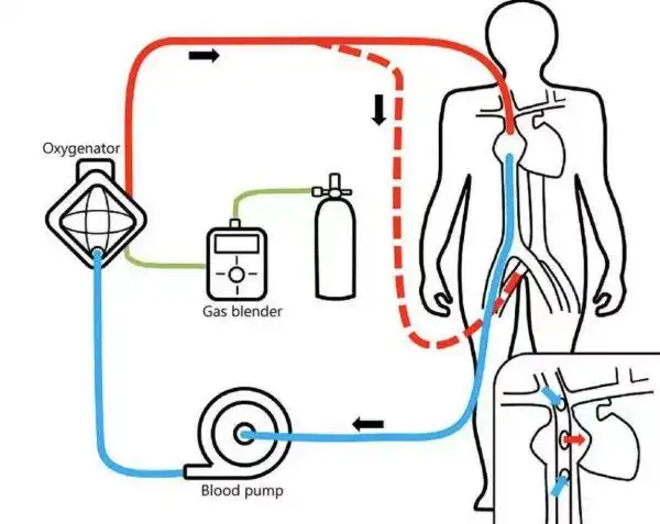 【新技术新项目】ecmo(体外膜肺氧合)技术落户普洱市人民医院重症医学