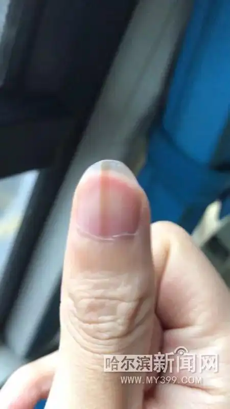 指甲长了一条黑线就是癌原来还有这种病发现赶紧上医院