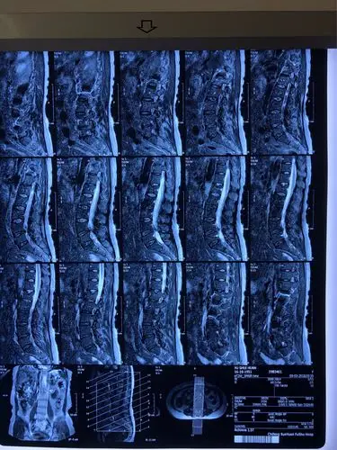 赤峰学院附属医院首例经椎板间隙入路经皮内镜下腰椎间盘切除术3月11