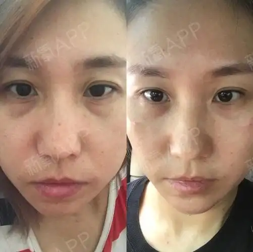 玻尿酸填充泪沟