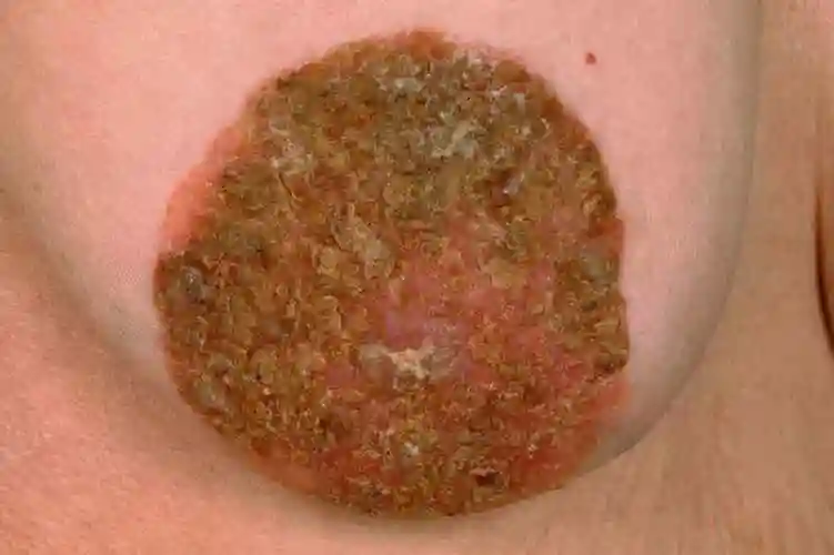 按照湿疹治疗没有效果的,要及早做活检来确定是否是这种癌变.