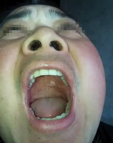 口腔囊肿 (24)_有来医生