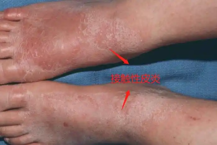 脚部接触性皮炎