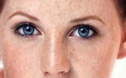 脸上长斑如何去除?知道这些,轻松祛斑