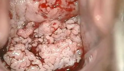 宫颈癌的早期症状图片 (9)