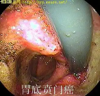 胃镜图片胃底贲门癌