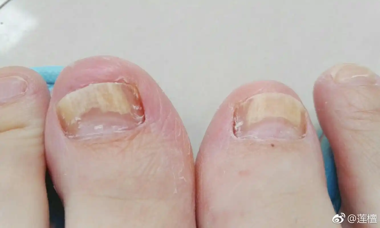 两个脚的大拇指指甲病变已经好几年了(如上图),去医院检查,抽血没有
