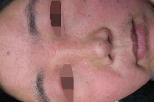 过敏脸上的皮肤可能会变红,有时会出现脓泡,水泡,瘙痒,糜烂等症状