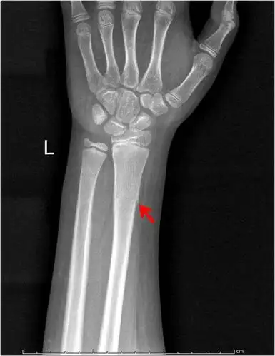 有一种骨折青睐儿童跟成人的x线不同
