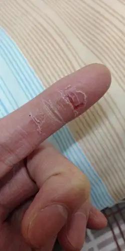 这只手指干裂得很.不痕痒但会痛.只要把干裂啲皮撕掉就会很痛.