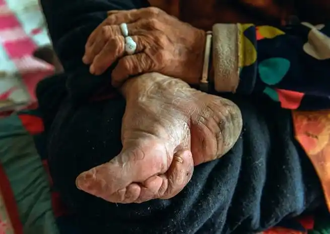 使用长布条缠裹小脚.使用线绳将缠裹在小脚上的长布条上进行牢固.