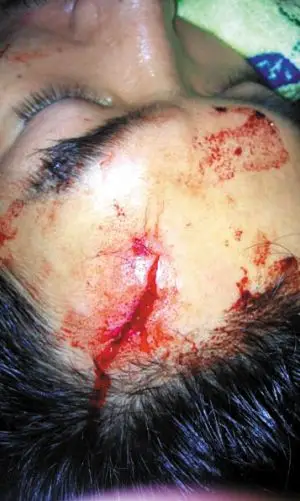 朱泳腾拍戏时头部受伤