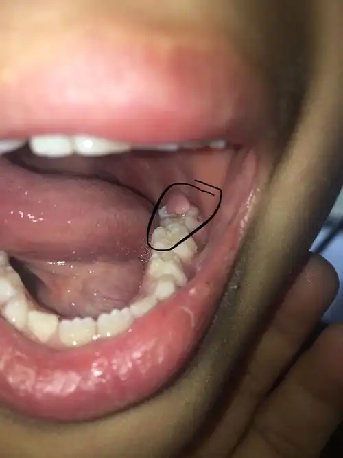 孩子牙根长个肉丁怎么回事 今早才发现